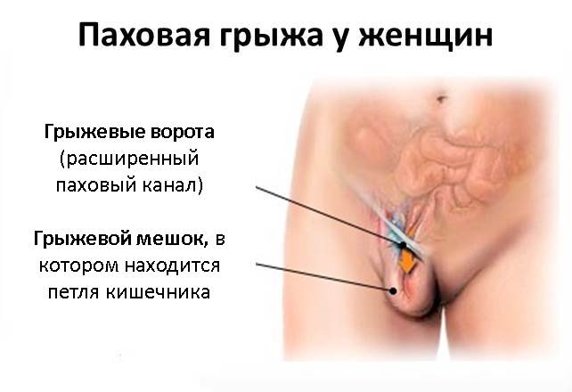 Изображение 4: Грыжа живота - клиника Семейный доктор