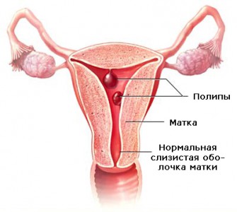 Изображение 1: Полипы матки - клиника Семейный доктор