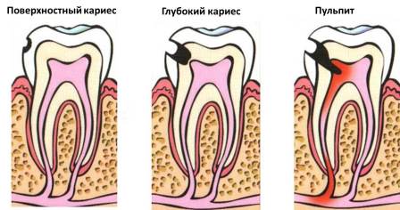 Изображение 2: Пульпит - клиника Семейный доктор