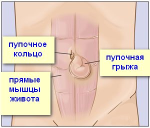 Изображение 6: Грыжа живота - клиника Семейный доктор