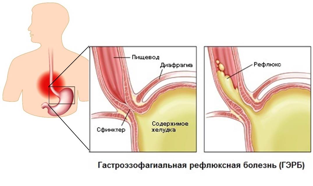 Которым можно отравиться употреблением горьких вещей