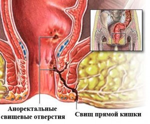 Изображение 1: Свищ прямой кишки - клиника Семейный доктор