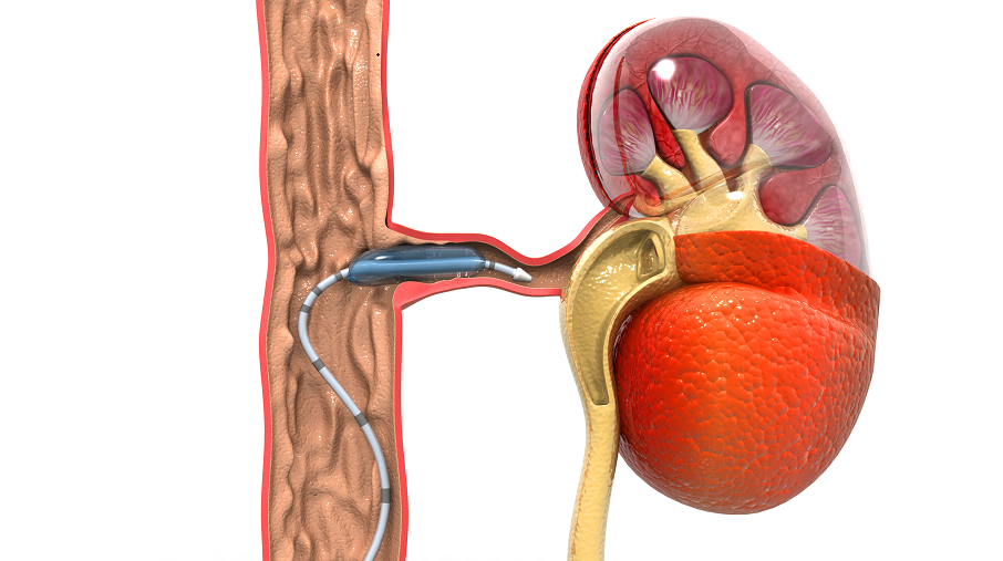 Баллонная ангиопластика и стентирование почечных артерий