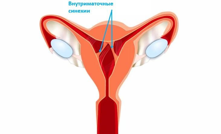 Внутриматочные синехии