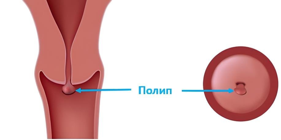 Полип цервикального канала