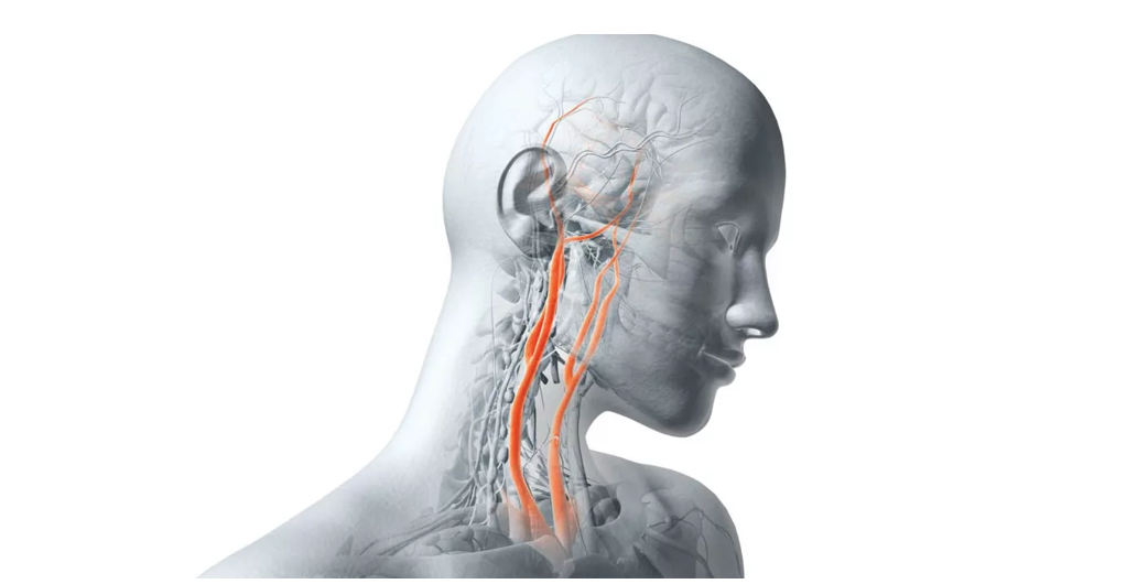 Баллонная ангиопластика и стентирование сонных артерий