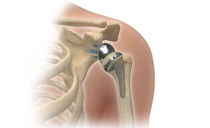 Эндопротезирование плечевого сустава