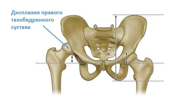 Дисплазия тазобедренного сустава