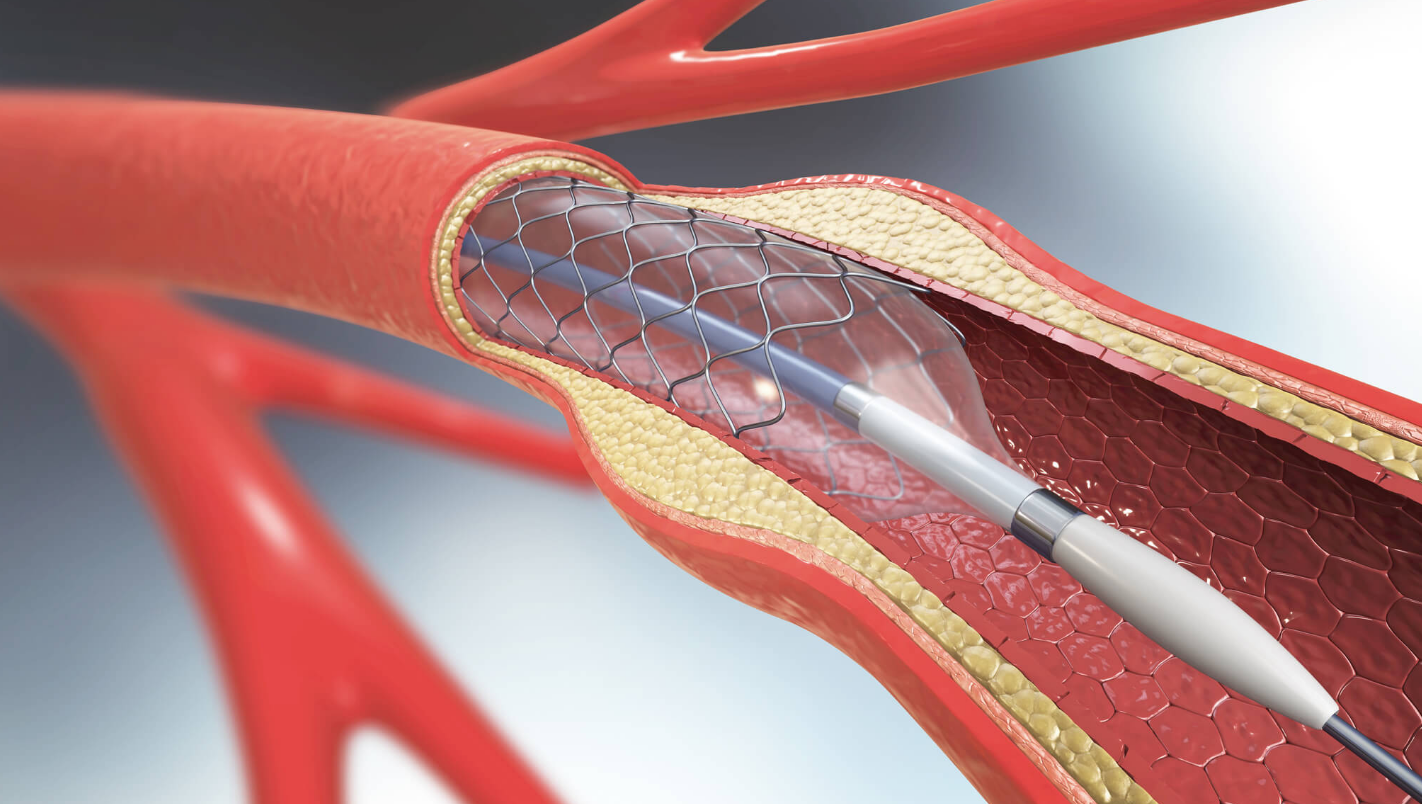 Баллонная ангиопластика и стентирование мезентериальных артерий