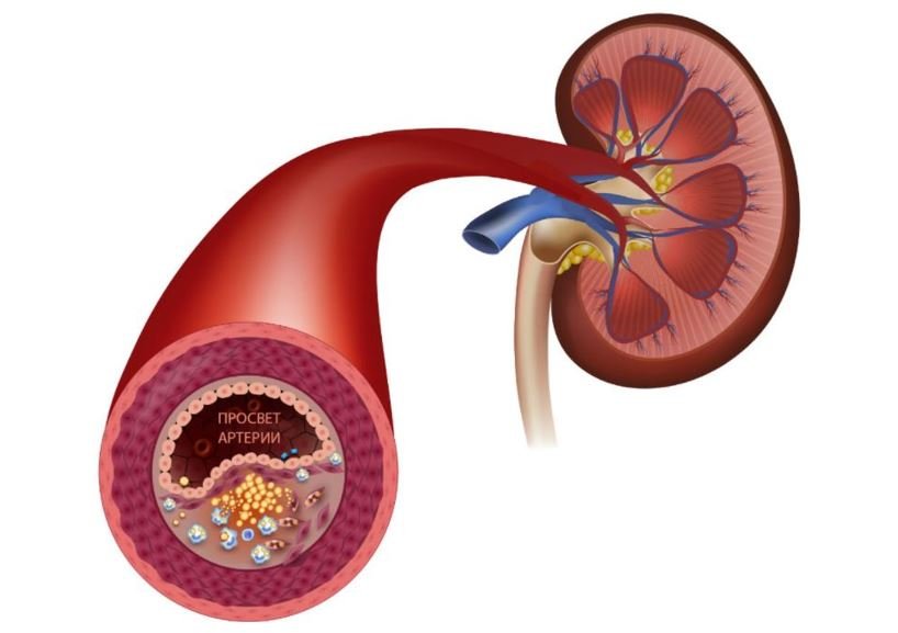 Заболевание почечных артерий