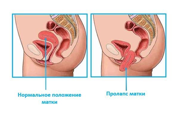 Выпадение матки