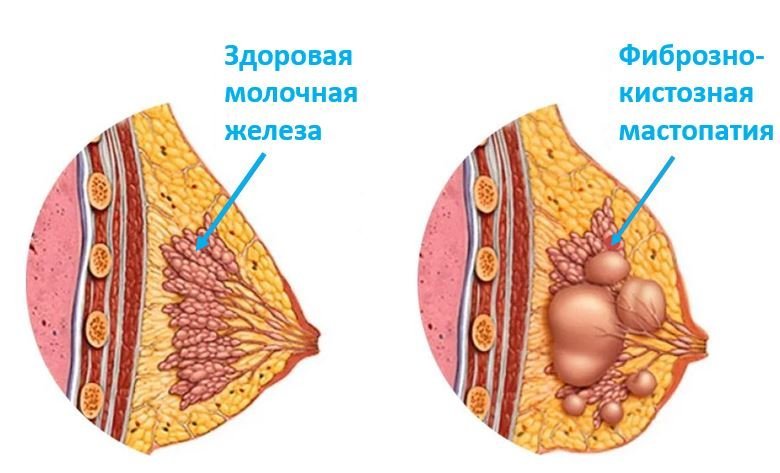 Фиброзно-кистозная мастопатия