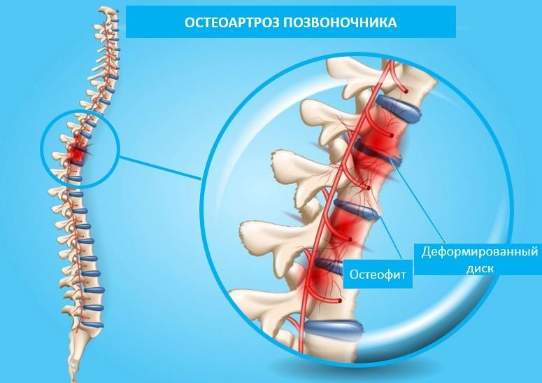 Остеоартроз позвоночника