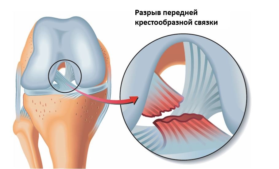 Разрывы связок