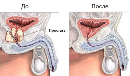 Простатэктомия