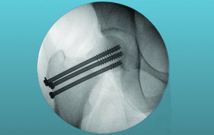 Остеосинтез при переломе шейки бедра
