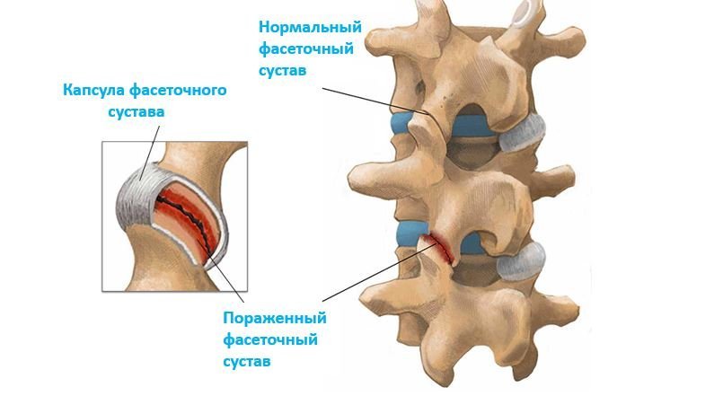 Фасеточный синдром