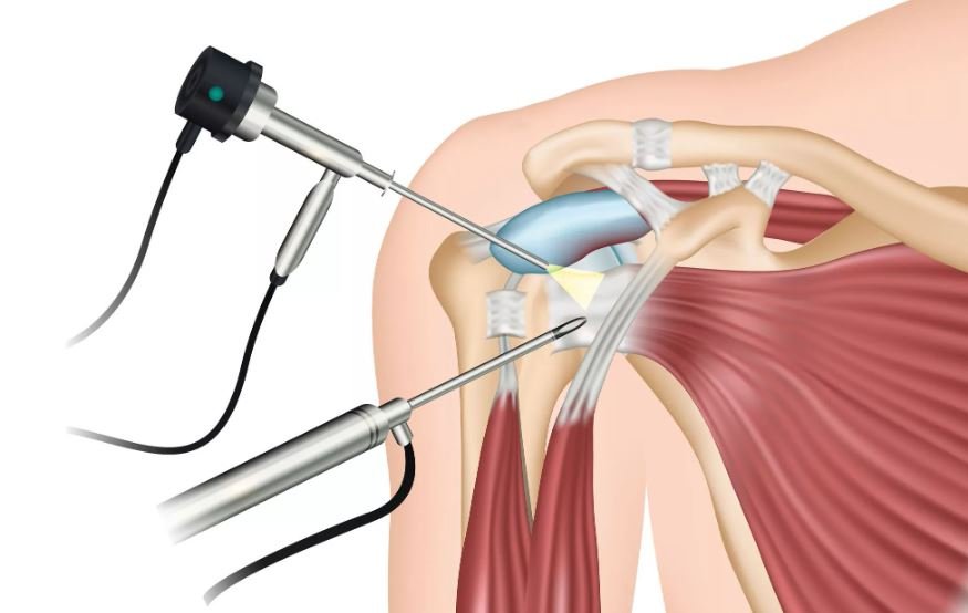 Артроскопия плечевого сустава