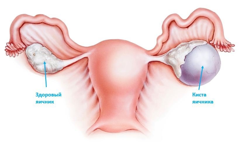 Киста яичника
