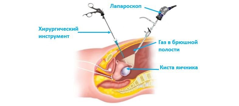 Удаление кисты яичника