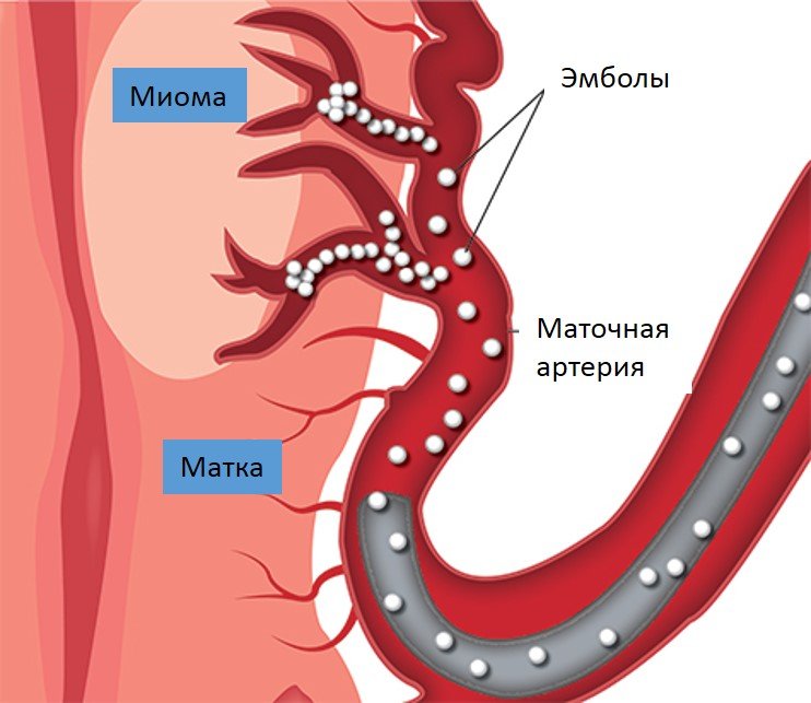 Что такое эмболизация маточных артерий