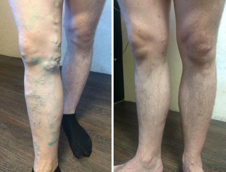 perna ortopedica pentru picior varicoza