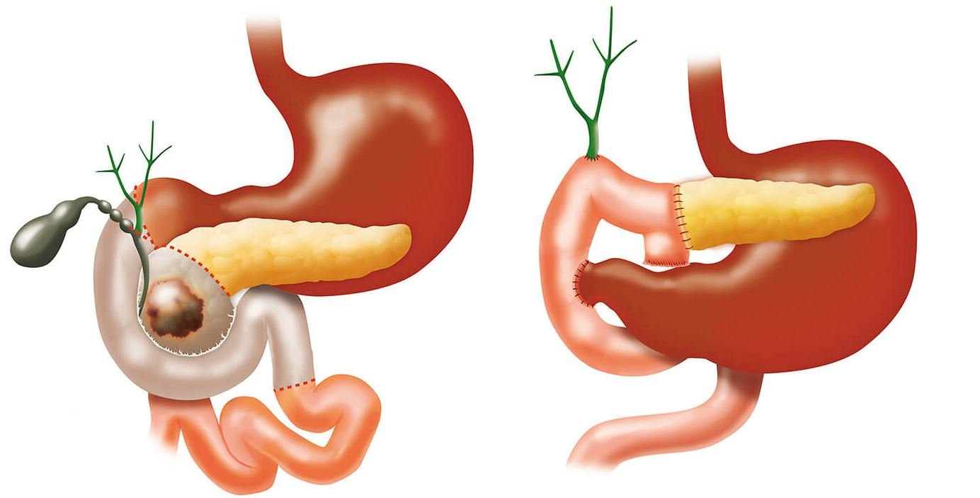 Гастропанкреатодуоденальная резекция