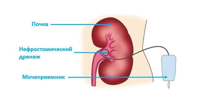Нефростомия