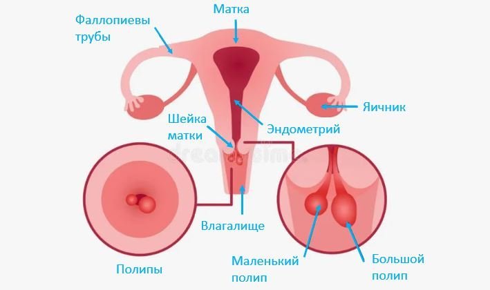 Полип шейки матки