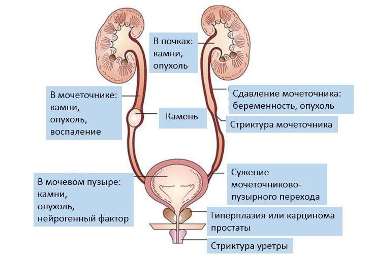 Обструктивные уропатии