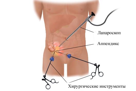 Аппендэктомия