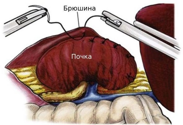 Нефропексия