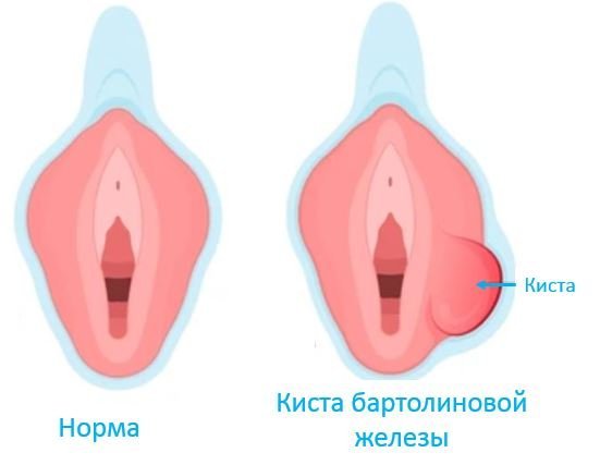 Киста бартолиновой железы