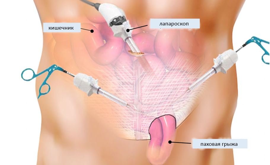 Лапароскопическая герниопластика
