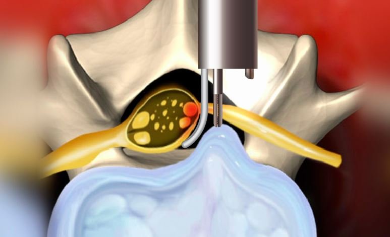 Микродискэктомия