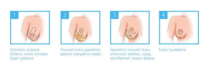 Маммопластика - Госпитальный центр Семейного доктора - Изображение 6