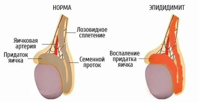 Эпидидимит - Сеть клиник АО "Семейный доктор", изображение 1