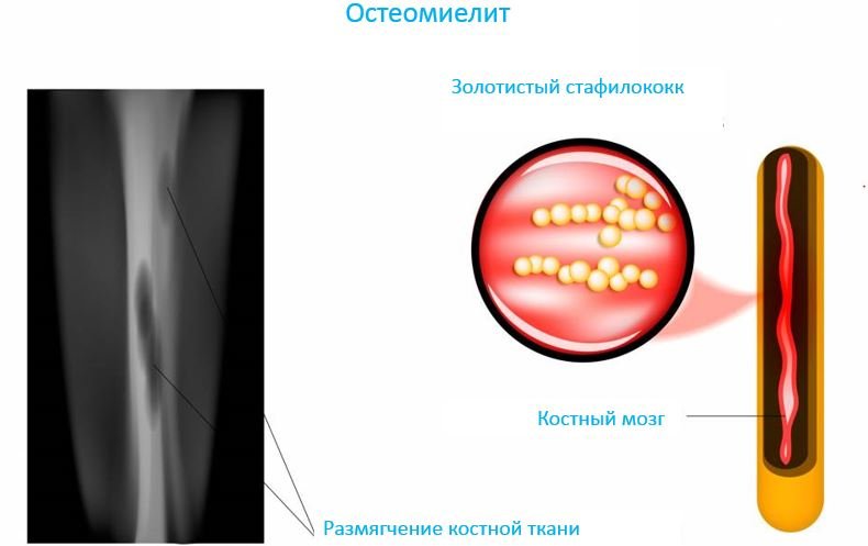 Остеомиелит - Сеть клиник АО Семейный доктор (Москва) - Изображение 1