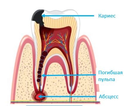 Периодонтит - Сеть клиник Семейный доктор (Москва) - Изображение 2