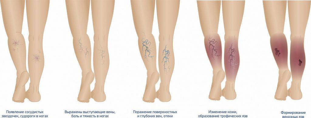 Хроническая венозная недостаточность - Сеть клиник АО Семейный доктор (Москва) - Фото 2