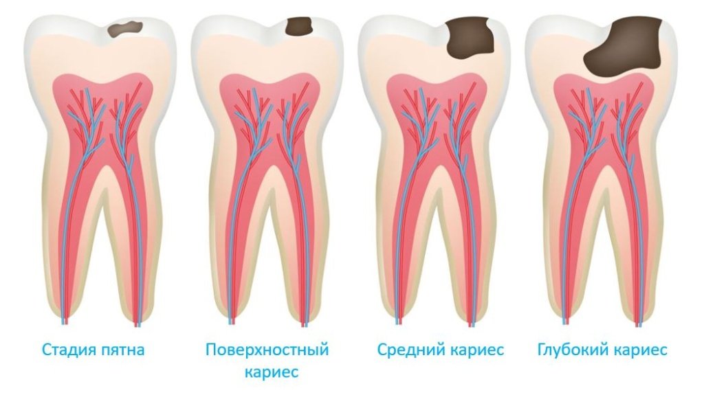 Кариес - Сеть клиник АО Семейный доктор (Москва) - Изображение 2