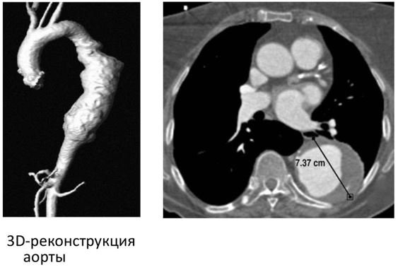 КТ-ангиография грудного отдела аорты - Сеть клиник АО Семейный доктор (Москва) - Фото 1