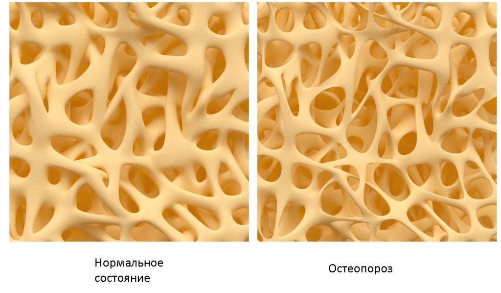 Что такое остеопороз - Сеть клиник АО Семейный доктор - Фото 1