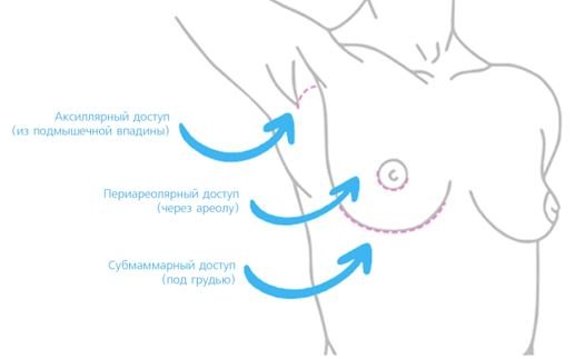 Маммопластика - Госпитальный центр Семейного доктора - Изображение 1