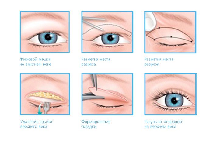 Блефаропластика.jpg