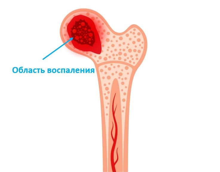 Остеомиелит - Сеть клиник АО Семейный доктор (Москва) - Изображение 1