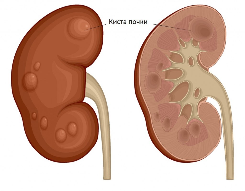 Киста почки - Сеть клиник АО Семейный доктор (Москва) - Рисунок 1