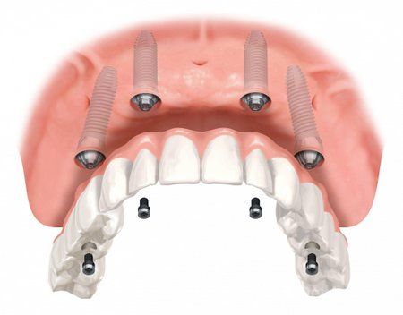 implant2.jpg implant2.jpg