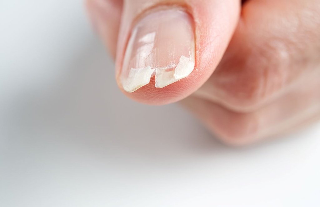 Ломкость ногтей - Сеть клиник АО Семейный доктор (Москва) - Изображение 1