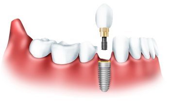 Имплантация implant1.jpg